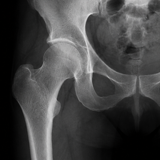 Hip joint replacement surgery