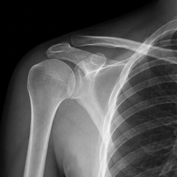 Shoulder and elbow surgery