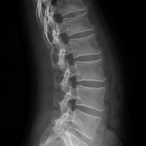 Spinal surgery for back and neck pain